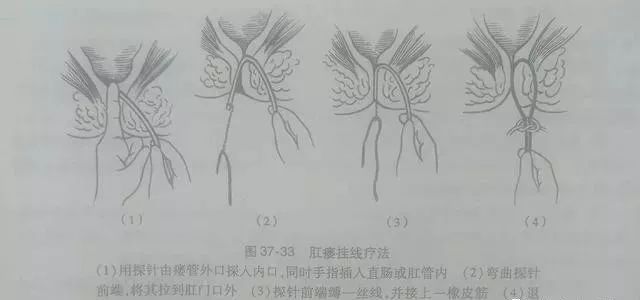 肛瘺的最新治療方法,肛瘺的最新治療方法