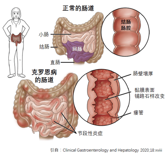 克羅恩最新治療方法,克羅恩病最新治療方法研究與應(yīng)用