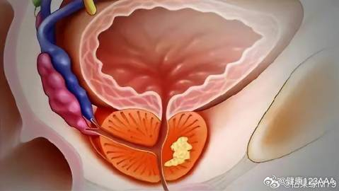 前列腺炎最新治療技術(shù),前列腺炎最新治療技術(shù)，打開健康之門的關(guān)鍵